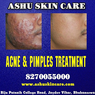 acne and pimples clinic