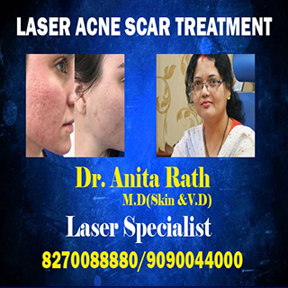 laser pimples scar treatment